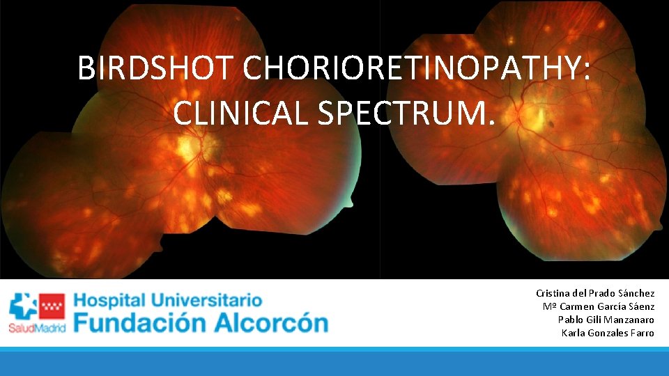 BIRDSHOT CHORIORETINOPATHY: CLINICAL SPECTRUM. Cristina del Prado Sánchez Mº Carmen García Sáenz Pablo Gili