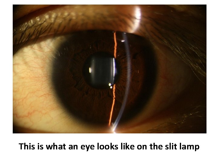This is what an eye looks like on the slit lamp 