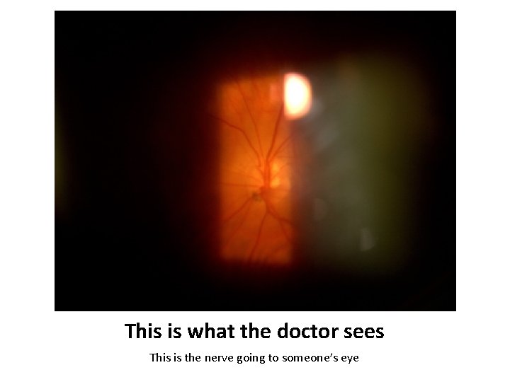This is what the doctor sees This is the nerve going to someone’s eye