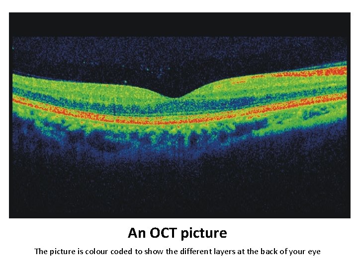 An OCT picture The picture is colour coded to show the different layers at