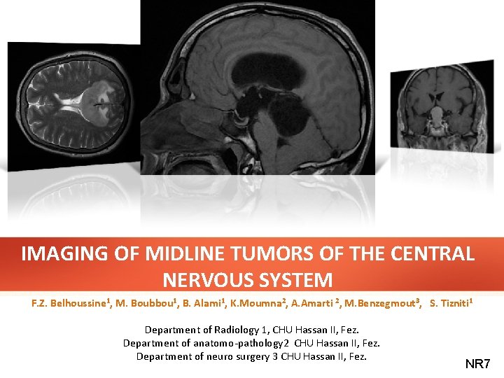 IMAGING OF MIDLINE TUMORS OF THE CENTRAL NERVOUS SYSTEM F. Z. Belhoussine 1, M.