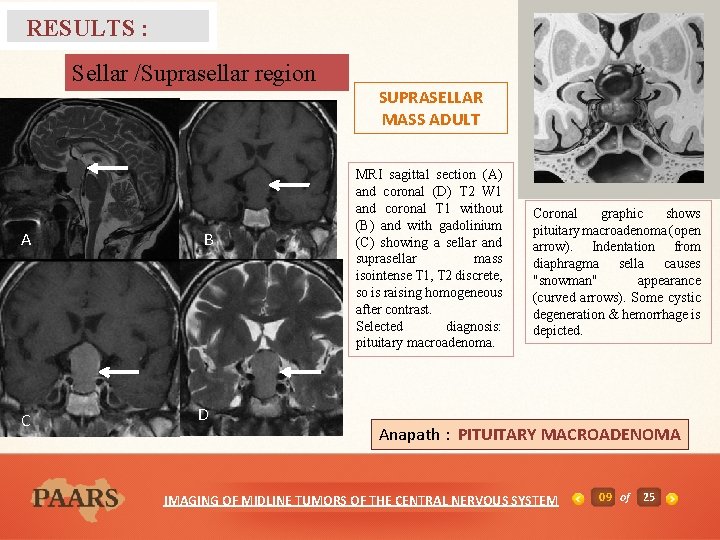 RESULTS : Sellar /Suprasellar region A B C D SUPRASELLAR MASS ADULT MRI sagittal