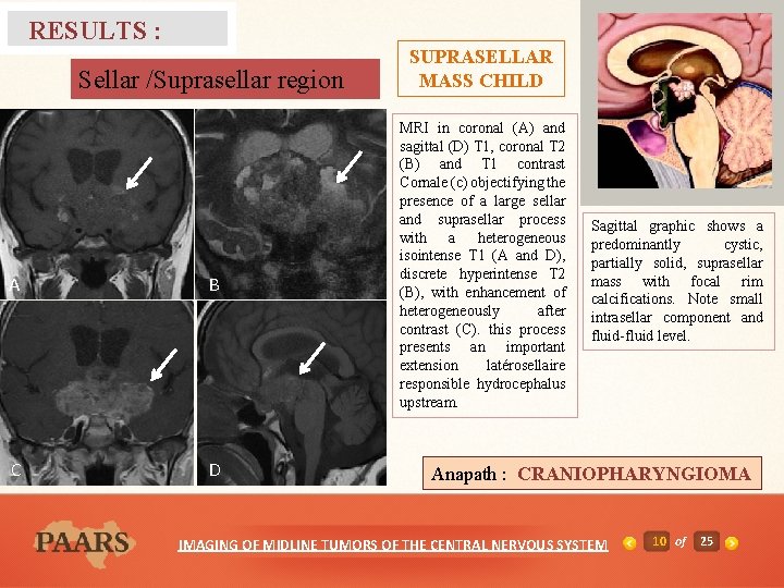 RESULTS : Sellar /Suprasellar region A B C D SUPRASELLAR MASS CHILD MRI in