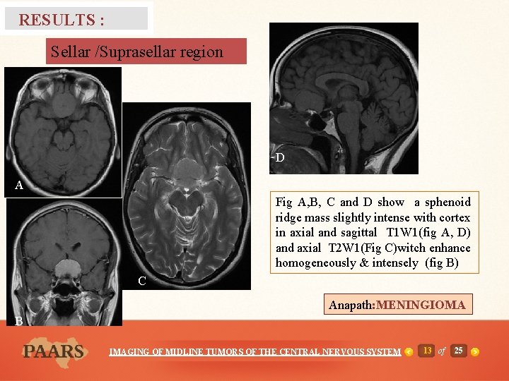 RESULTS : Sellar /Suprasellar region D A Fig A, B, C and D show