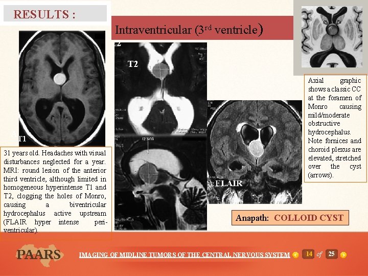 RESULTS : Intraventricular (3 rd ventricle) T 2 Axial graphic shows a classic CC