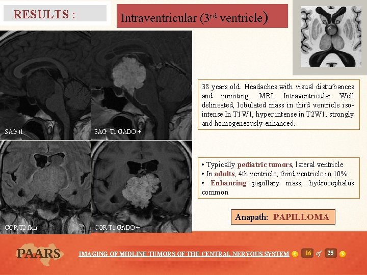 Intraventricular (3 rd ventricle) RESULTS : T 2 38 years old. Headaches with visual