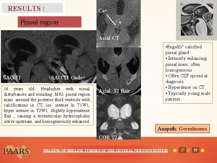 RESULTS : Ca+ Pineal region T 2 Axial CT D SAG T 1 A