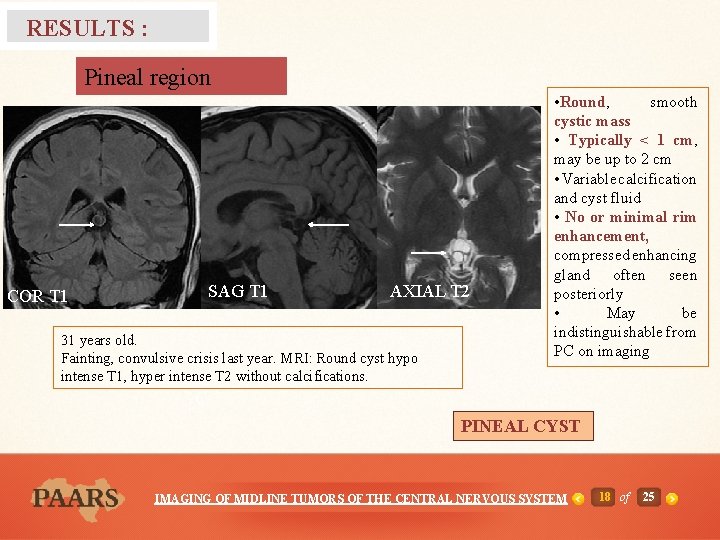 RESULTS : Pineal region T 2 D A SAG t 1 SAG T 1