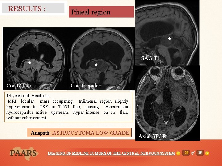 RESULTS : Pineal region SAG T 1 Cor T 2 flair Cor T 1