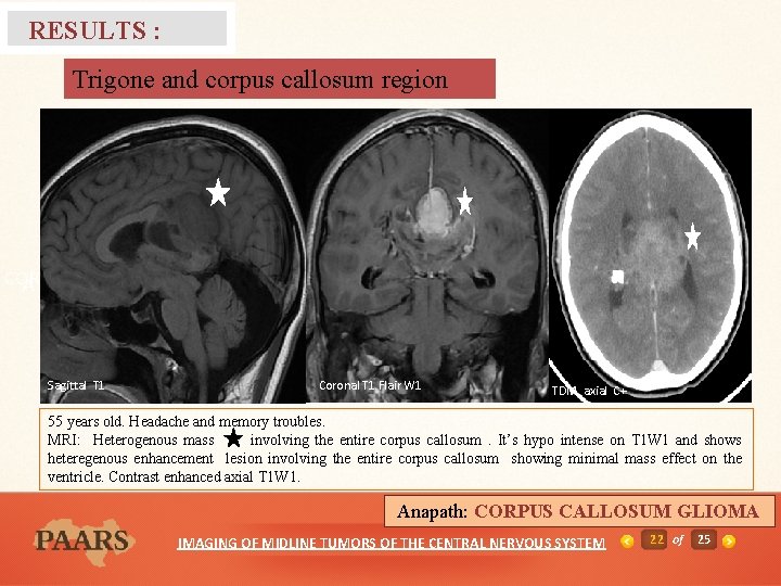 RESULTS : Trigone and corpus callosum region T 2 Axial T 2 D COR