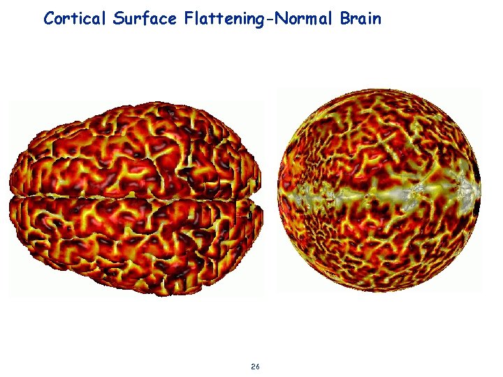 Cortical Surface Flattening-Normal Brain 26 
