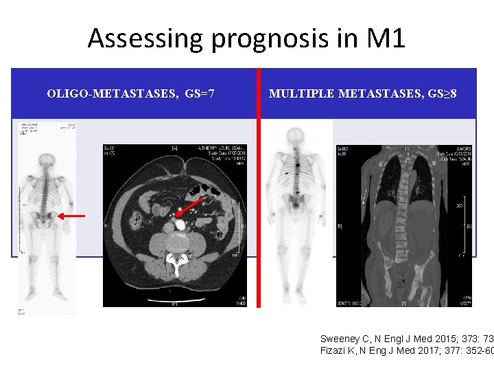 Assessing prognosis in M 1 OLIGO-METASTASES, GS=7 MULTIPLE METASTASES, GS≥ 8 Sweeney C, N