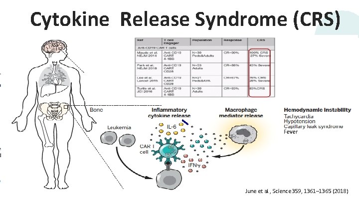 Cytokine Release Syndrome (CRS) Fever 24 (2018) June et al. , Science 359, 1361–