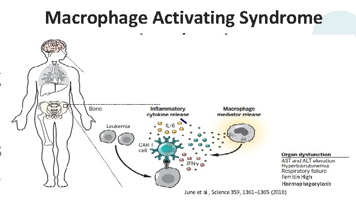 Macrophage Activating Syndrome (HLH/MAS) Ferritin High Haemophagocytosis 26 June et al. , Science 359,
