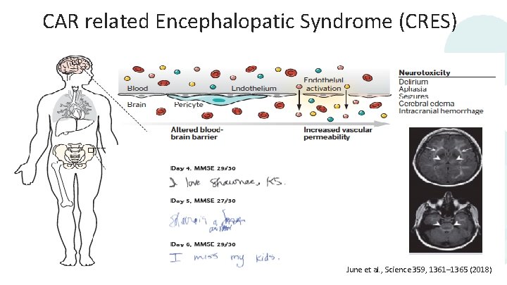 CAR related Encephalopatic Syndrome (CRES) Haemophagocitic syndrome 27 (2018) June et al. , Science