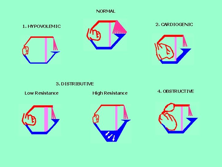 NORMAL 2. CARDIOGENIC 1. HYPOVOLEMIC 3. DISTRIBUTIVE Low Resistance High Resistance 4. OBSTRUCTIVE 