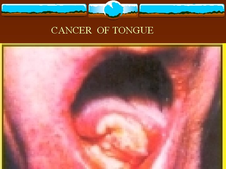 CANCER OF TONGUE 