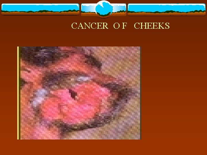 CANCER O F CHEEKS 