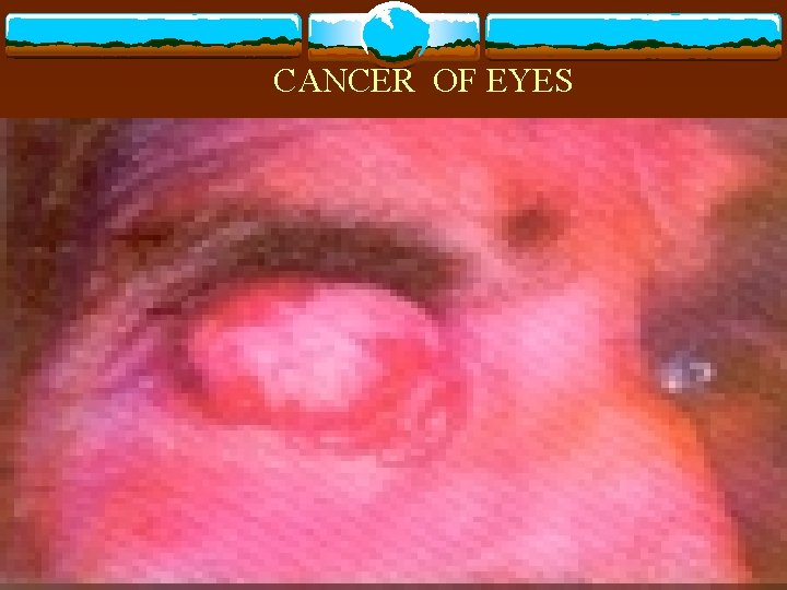 CANCER OF EYES 