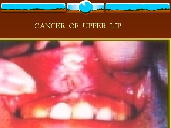 CANCER OF UPPER LIP 