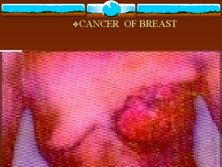 v. CANCER OF BREAST 