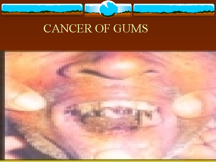 CANCER OF GUMS 