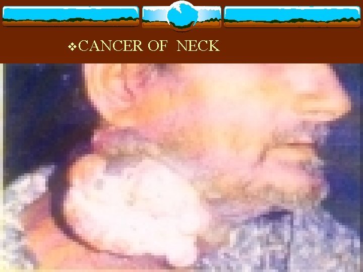 v. CANCER OF NECK 