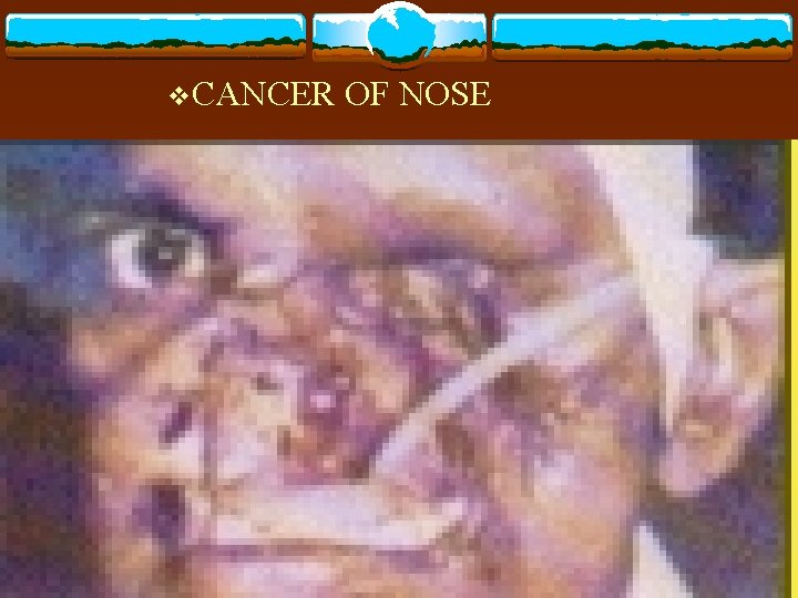 v. CANCER OF NOSE 