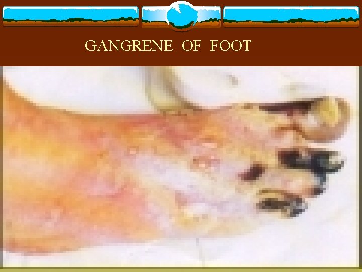 GANGRENE OF FOOT 