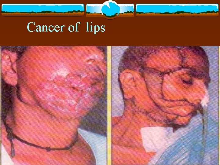 Cancer of lips 