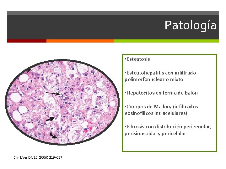 Patología • Esteatosis • Esteatohepatitis con infiltrado polimorfonuclear o mixto • Hepatocitos en forma