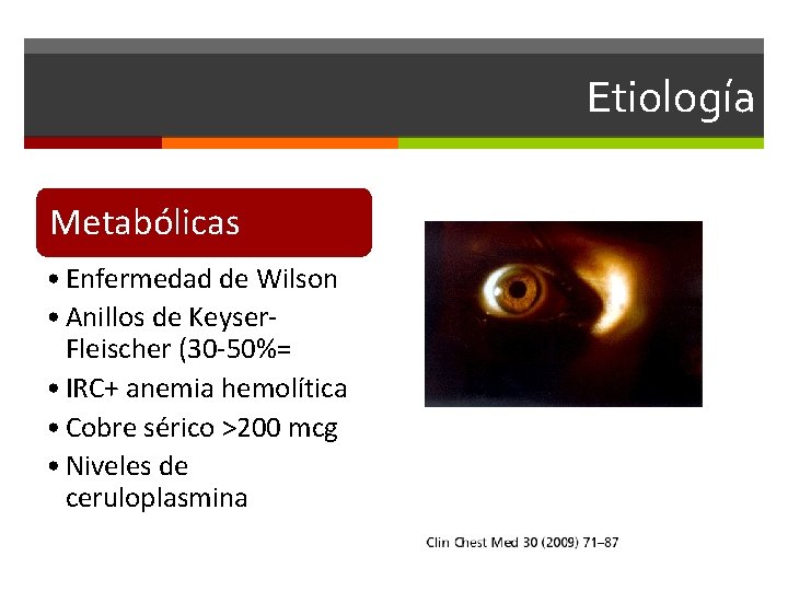 Etiología Metabólicas • Enfermedad de Wilson • Anillos de Keyser. Fleischer (30 -50%= •