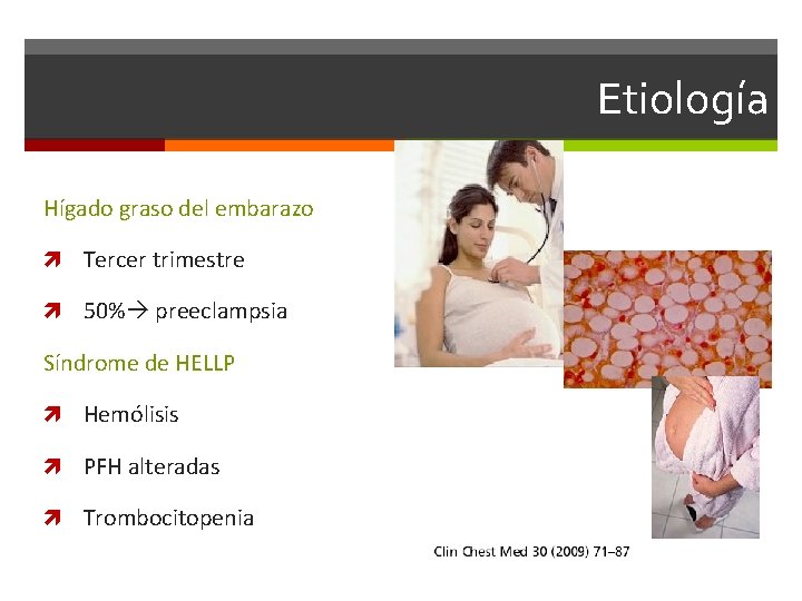 Etiología Hígado graso del embarazo Tercer trimestre 50% preeclampsia Síndrome de HELLP Hemólisis PFH