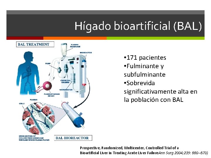 Hígado bioartificial (BAL) • 171 pacientes • Fulminante y subfulminante • Sobrevida significativamente alta