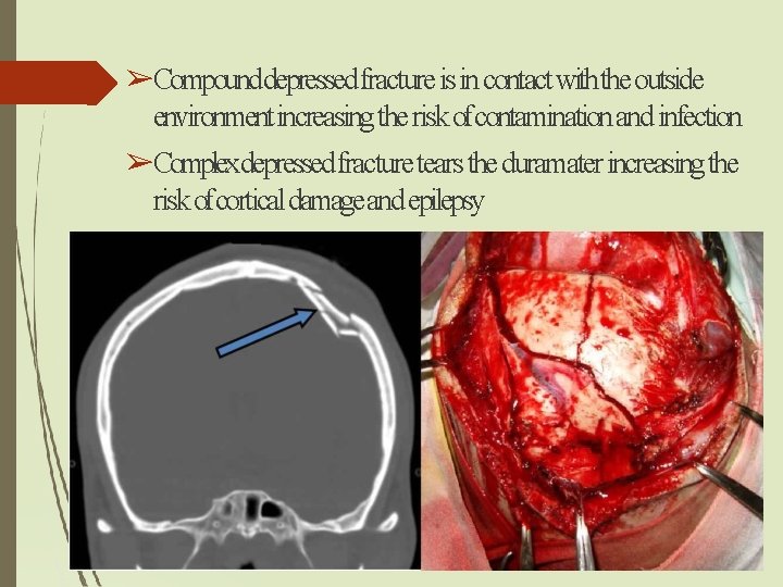 ➢Compounddepressed fracture is in contact withthe outside environment increasing the risk ofcontamination and infection ➢Compounddepressed fracture is in contact withthe outside environment increasing the risk ofcontamination and infection
