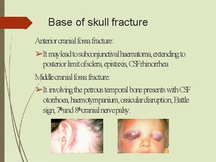 Base of skull fracture Anterior cranial fossa fracture: ➢It maylead to subconjunctival haematoma, extending Base of skull fracture Anterior cranial fossa fracture: ➢It maylead to subconjunctival haematoma, extending