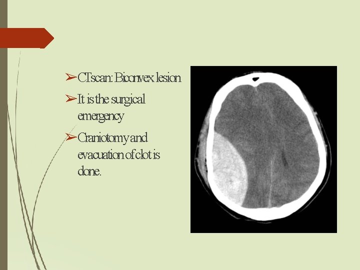 ➢CTscan: Biconvex lesion ➢It is the surgical emergency ➢Craniotomyand evacuation ofclot is done. ➢CTscan: Biconvex lesion ➢It is the surgical emergency ➢Craniotomyand evacuation ofclot is done.