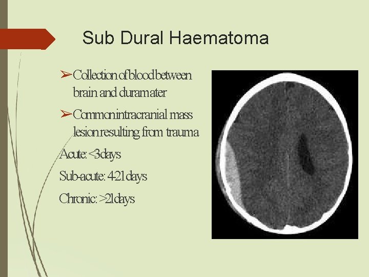Sub Dural Haematoma ➢Collectionofbloodbetween brain and duramater ➢Commonintracranial mass lesion resulting from trauma Acute: Sub Dural Haematoma ➢Collectionofbloodbetween brain and duramater ➢Commonintracranial mass lesion resulting from trauma Acute: