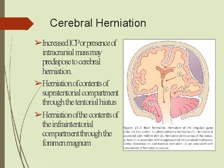 Cerebral Herniation ➢Increased ICPor presence of intracranial massmay predispose to cerebral herniation. ➢Herniation ofcontents Cerebral Herniation ➢Increased ICPor presence of intracranial massmay predispose to cerebral herniation. ➢Herniation ofcontents
