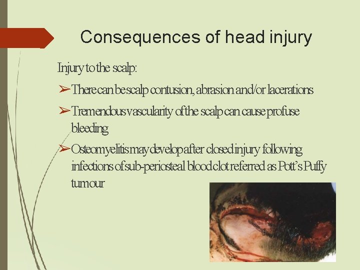 Consequences of head injury Injury to the scalp: ➢Therecan bescalp contusion, abrasion and/or lacerations Consequences of head injury Injury to the scalp: ➢Therecan bescalp contusion, abrasion and/or lacerations