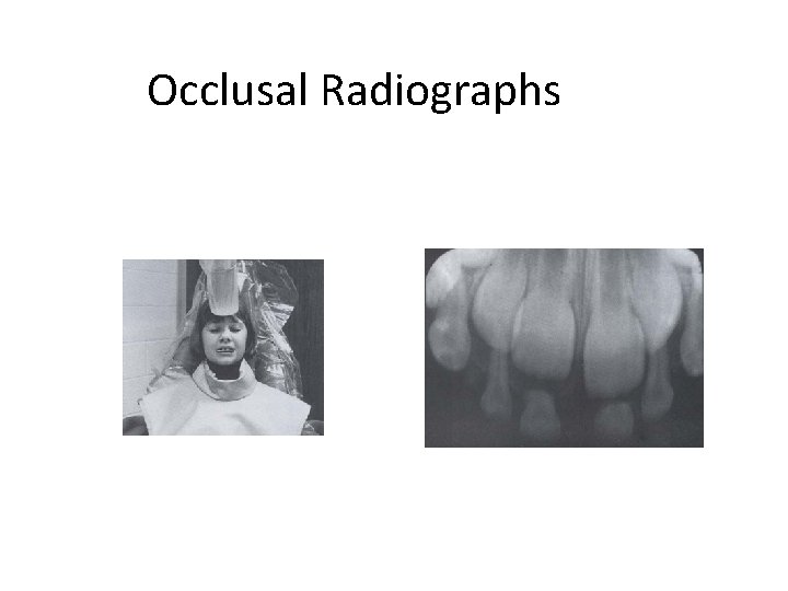 Occlusal Radiographs 
