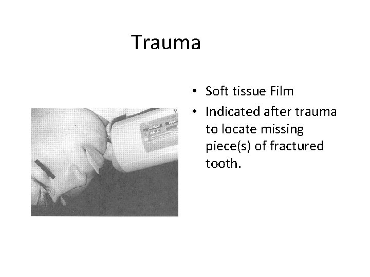 Trauma • Soft tissue Film • Indicated after trauma to locate missing piece(s) of