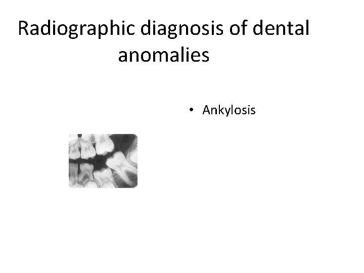 Radiographic diagnosis of dental anomalies • Ankylosis 