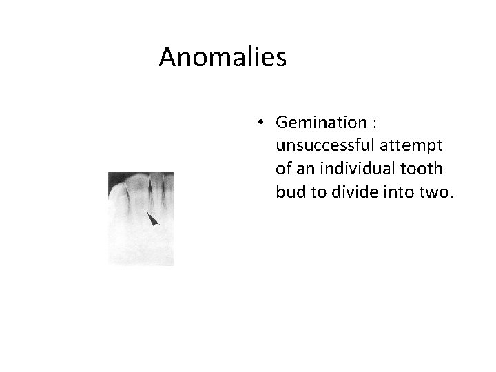 Anomalies • Gemination : unsuccessful attempt of an individual tooth bud to divide into