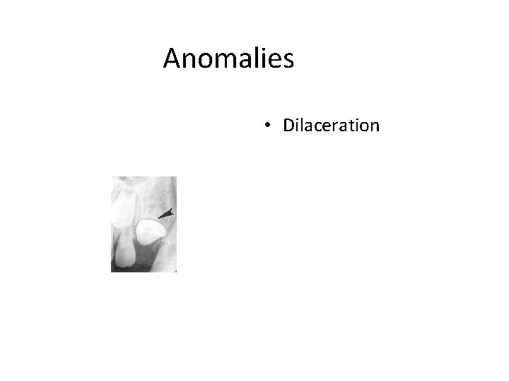 Anomalies • Dilaceration 