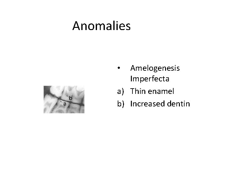 Anomalies Amelogenesis Imperfecta a) Thin enamel b) Increased dentin • 