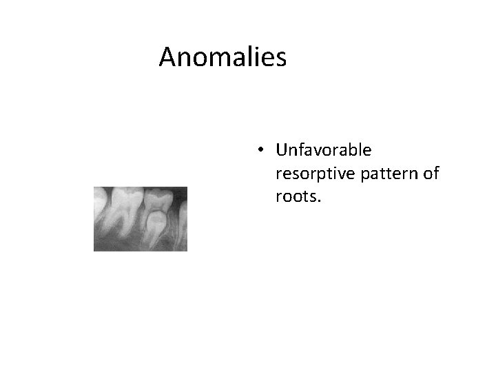 Anomalies • Unfavorable resorptive pattern of roots. 