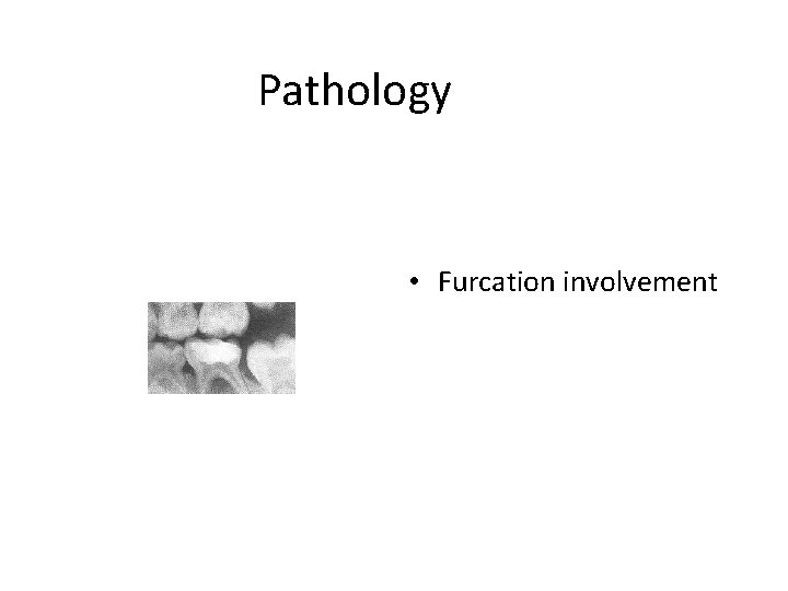Pathology • Furcation involvement 