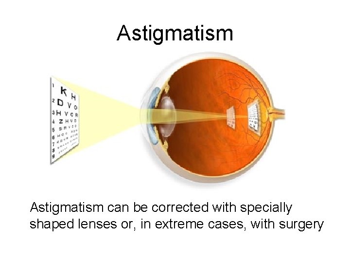 Astigmatism can be corrected with specially shaped lenses or, in extreme cases, with surgery