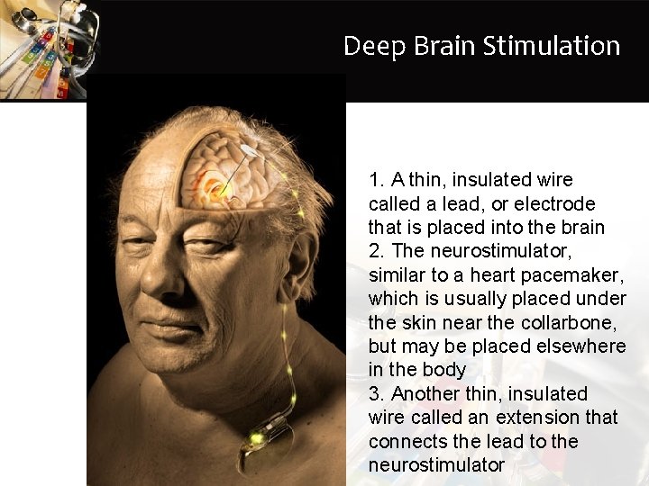 Deep Brain Stimulation 1. A thin, insulated wire called a lead, or electrode that